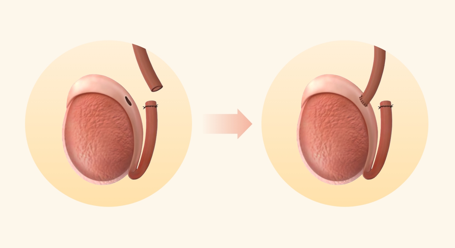 Vasoepididymostomy